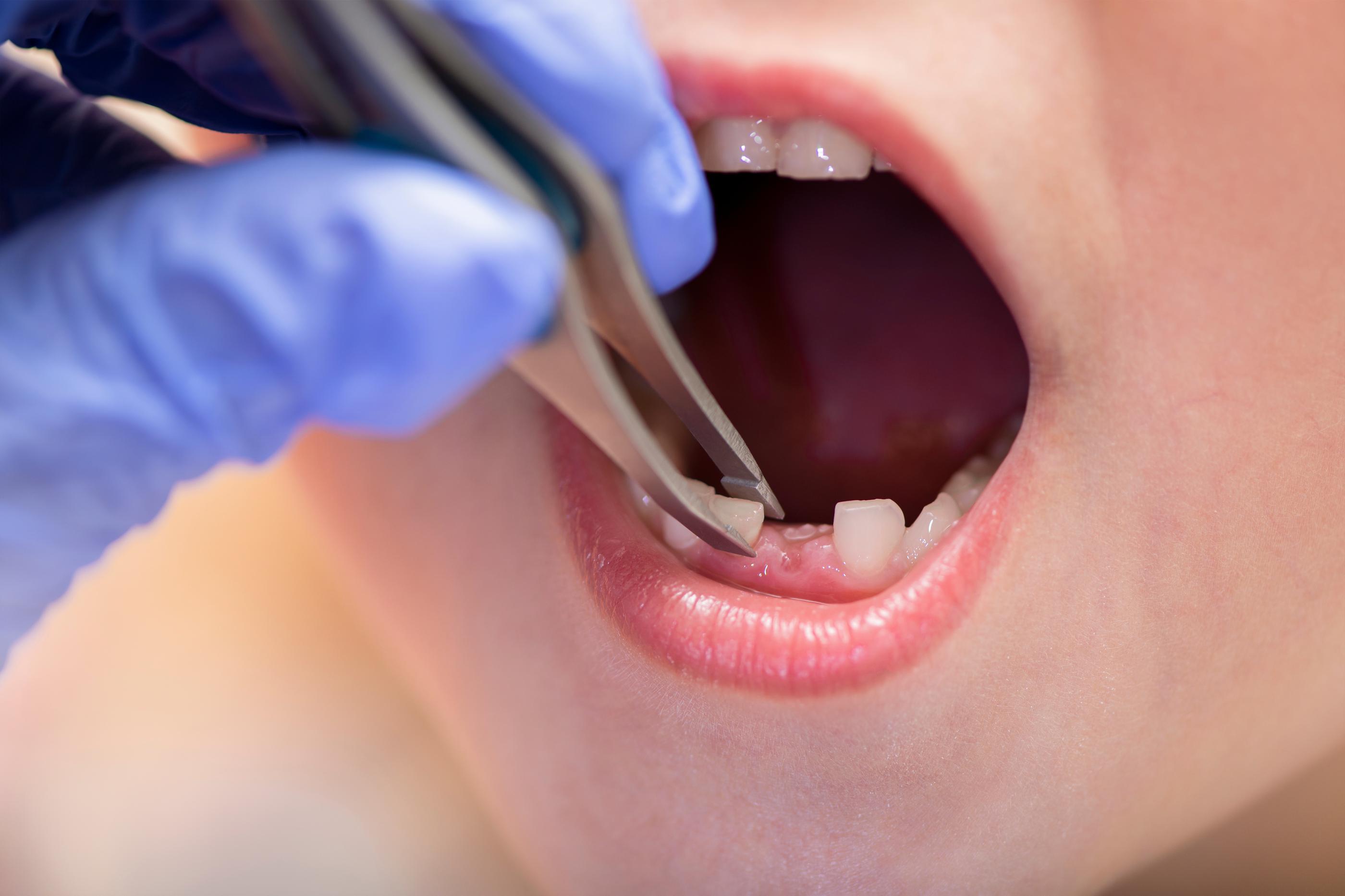 Childhood Tooth Extractions: Causes, Treatment & Aftercare