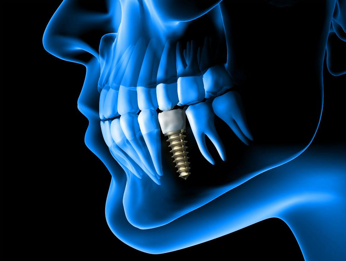 Dental Implants Simi Valley, CA